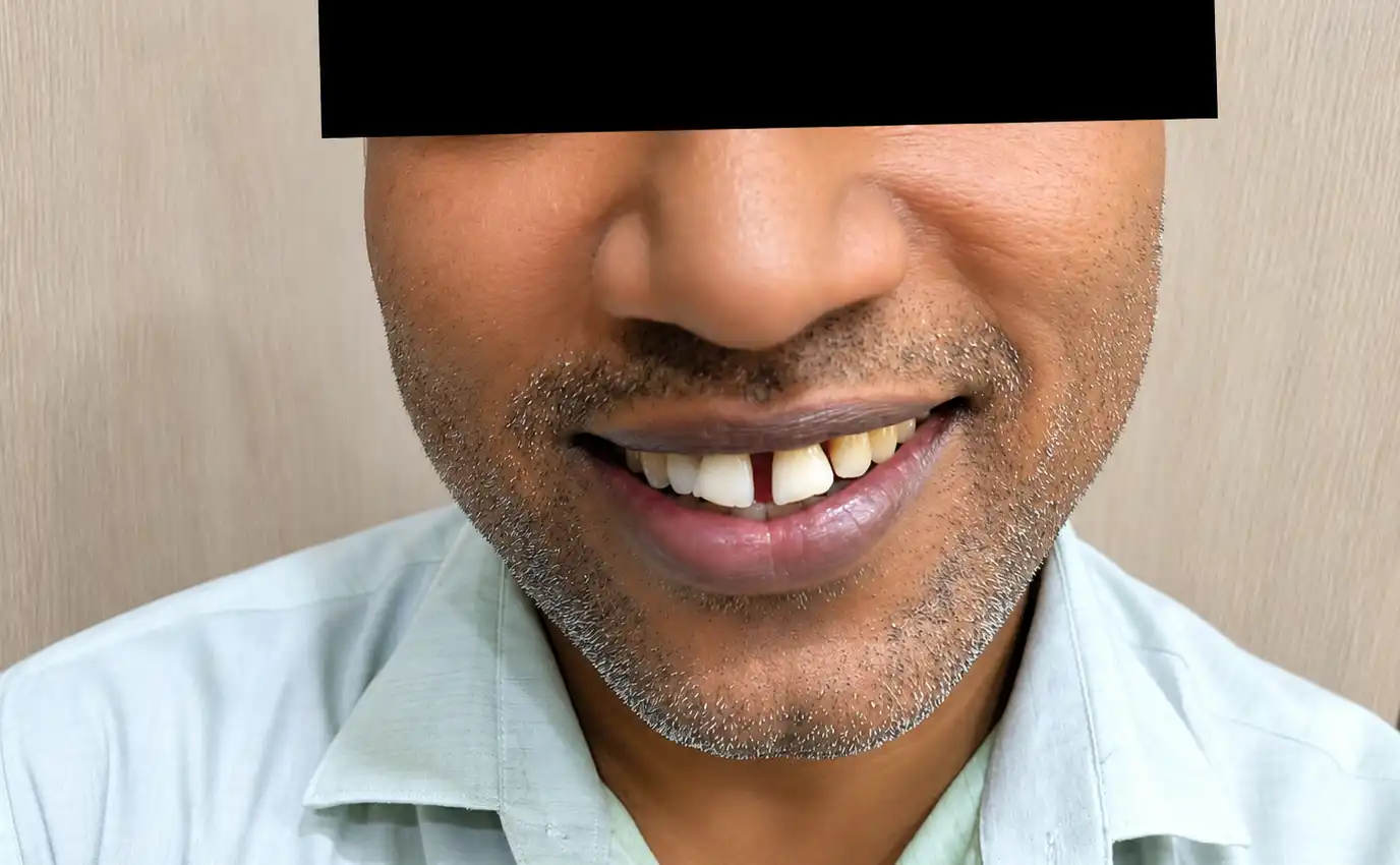 Smile Makeover — before treatment