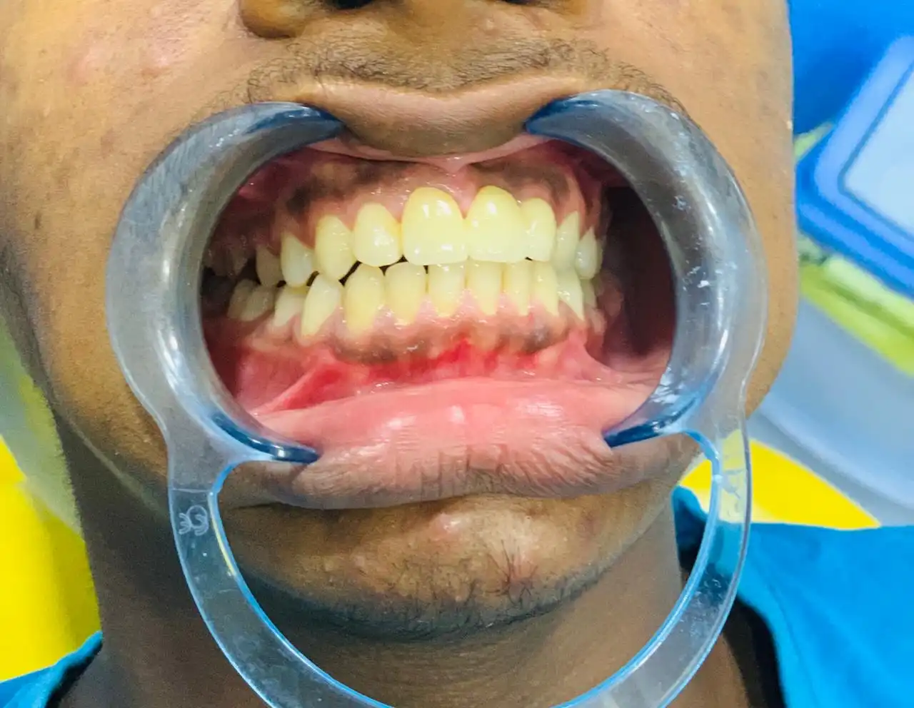 Orthodontic Correction — after treatment