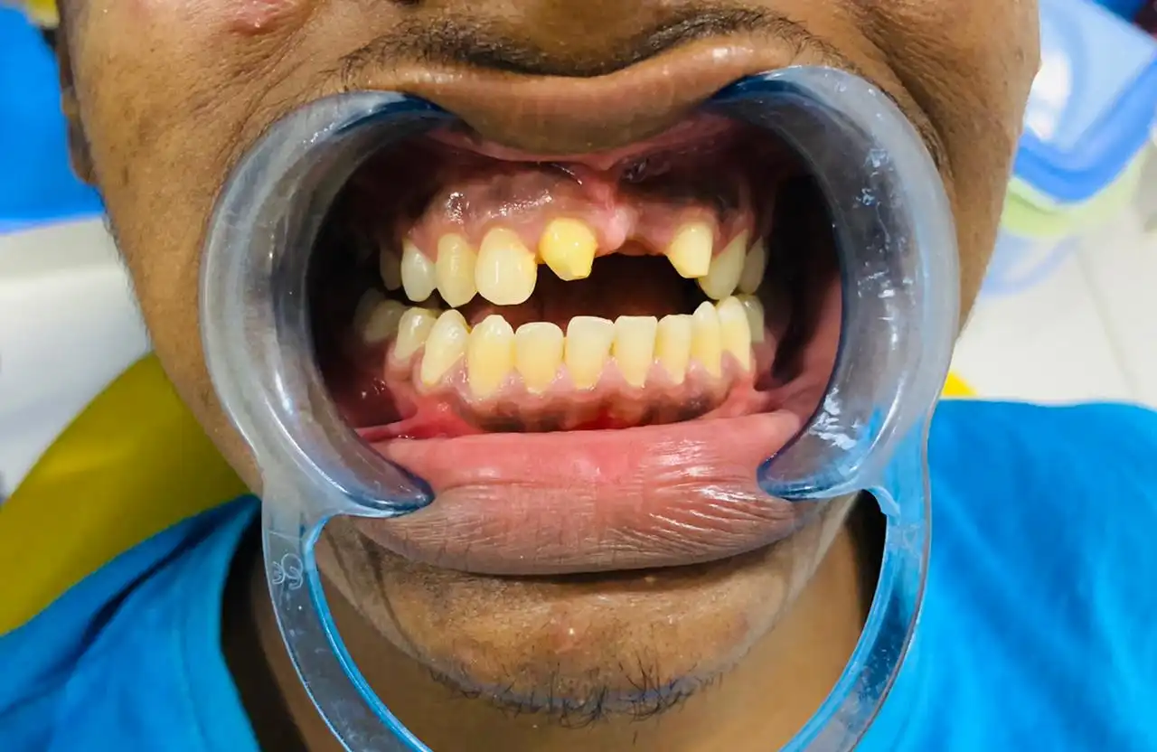 Orthodontic Correction — before treatment