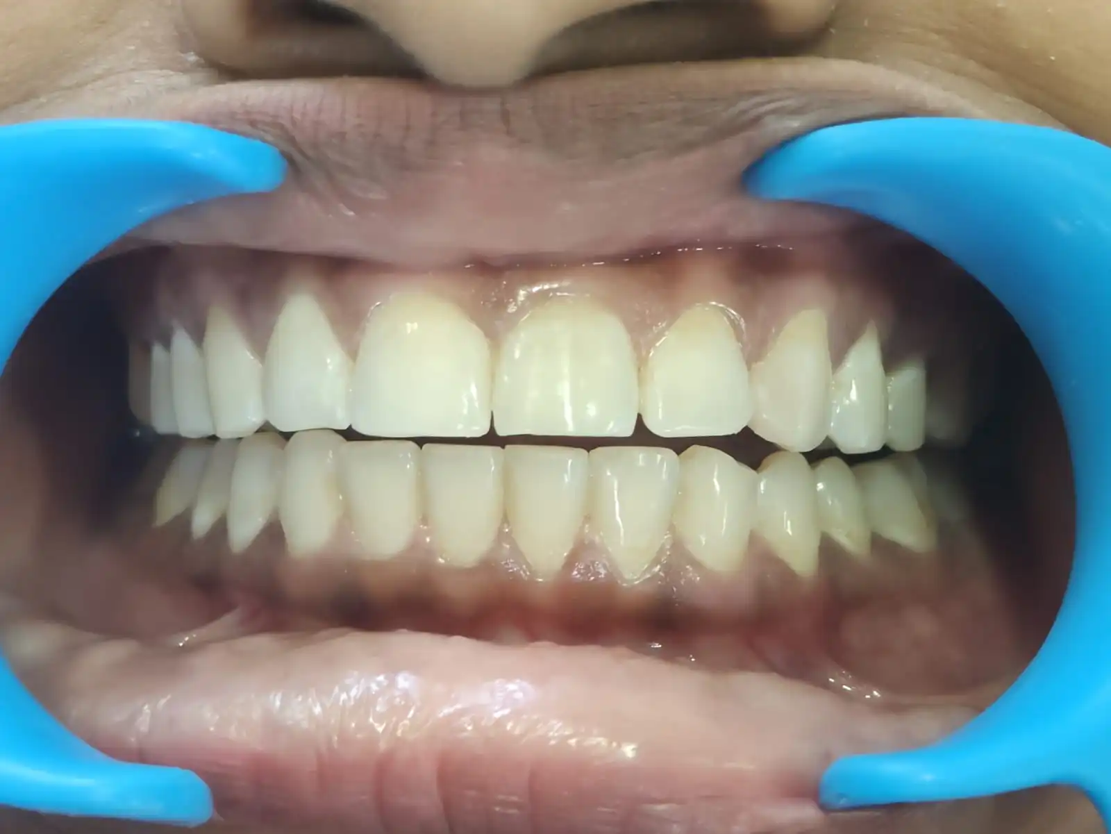 Diastema Closure — after treatment