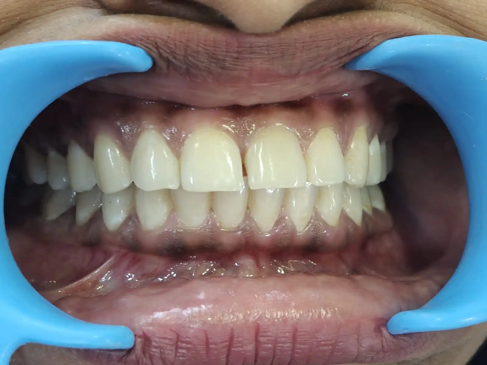 Diastema Closure — before treatment